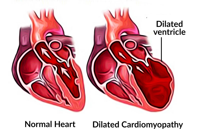Dilated cardiomyopathy (DCM) in dogs and cats